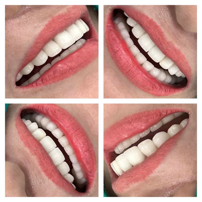 Hình ảnh quy trình bọc răng sứ công nghệ cao tại Tân Mỹ