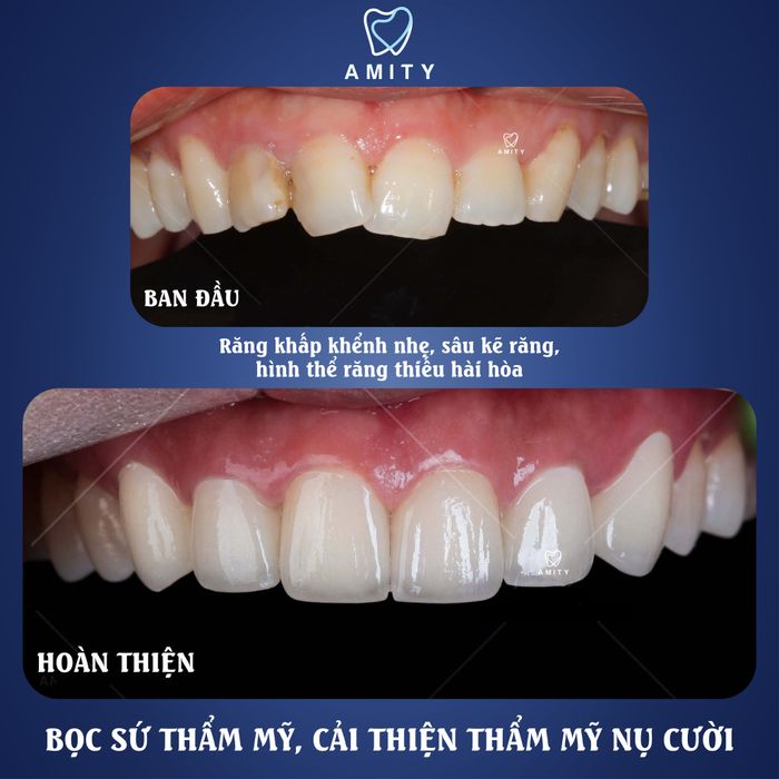Hình ảnh quy trình bọc răng sứ công nghệ cao tại Amity