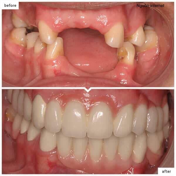Hình ảnh quy trình bọc răng sứ chuẩn y khoa tại Nha Khoa Nguyễn Đắc Cật