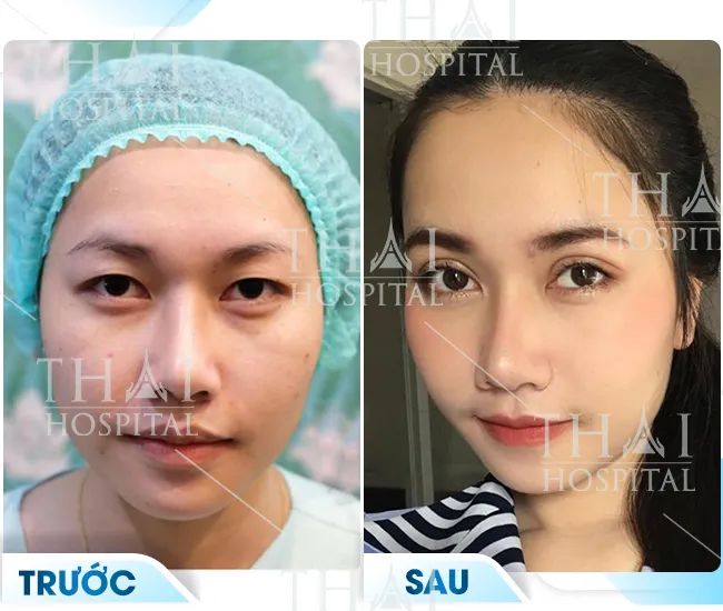 Hình ảnh thực tế quy trình cắt mí Mini Deep tại Thai Hospital