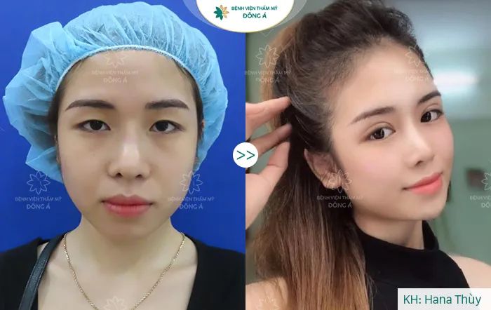 Hình ảnh thực tế quy trình cắt mí Natural Eyes tại Đông Á