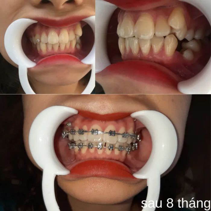 Hình ảnh quy trình niềng răng chuẩn y khoa tại Dr Smile