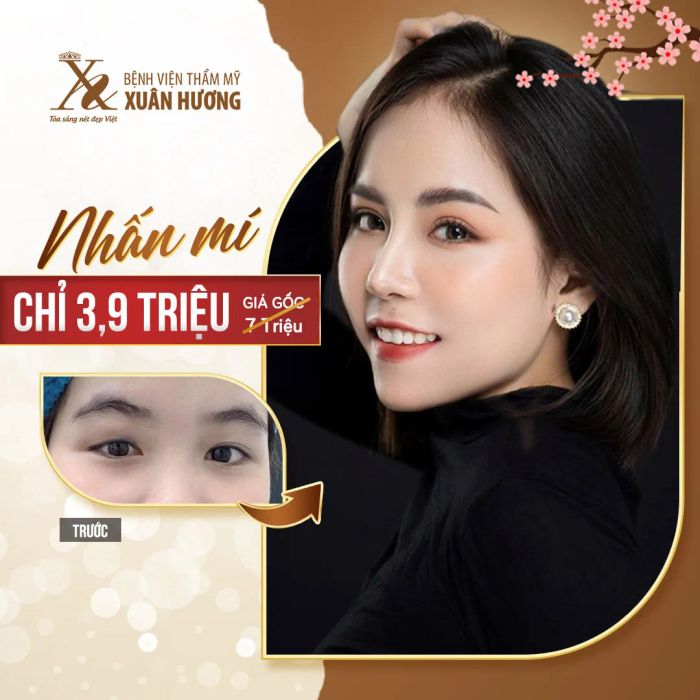 Hình ảnh thực tế quy trình cắt mí Mini Deep 6D tại Xuân Hương