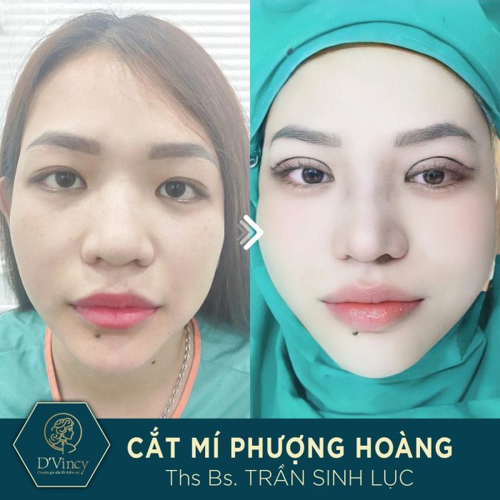 Hình ảnh thực tế quy trình cắt mí Phượng Hoàng tại D'Vincy