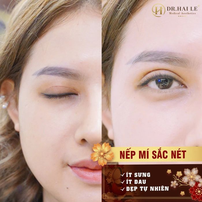 Hình ảnh thực tế quy trình cắt mí công nghệ cao tại Dr.Hải Lê