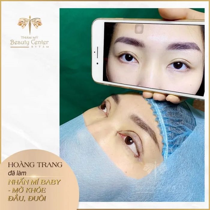 Hình ảnh thực tế quy trình thẩm mỹ mắt tại Beauty Center By Tấm