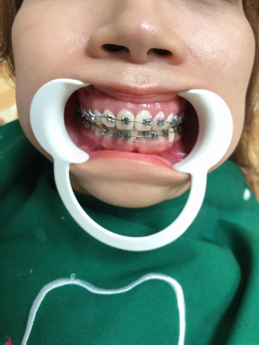 Hình ảnh quy trình niềng răng chuyên nghiệp tại Nacera