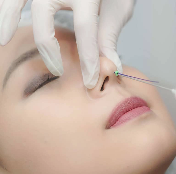 Nâng mũi bằng chỉ ảnh 2