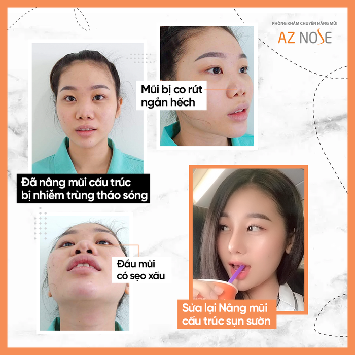 Hình ảnh thực tế tại AZ NOSE - Địa chỉ vàng cho các ca sửa mũi hỏng