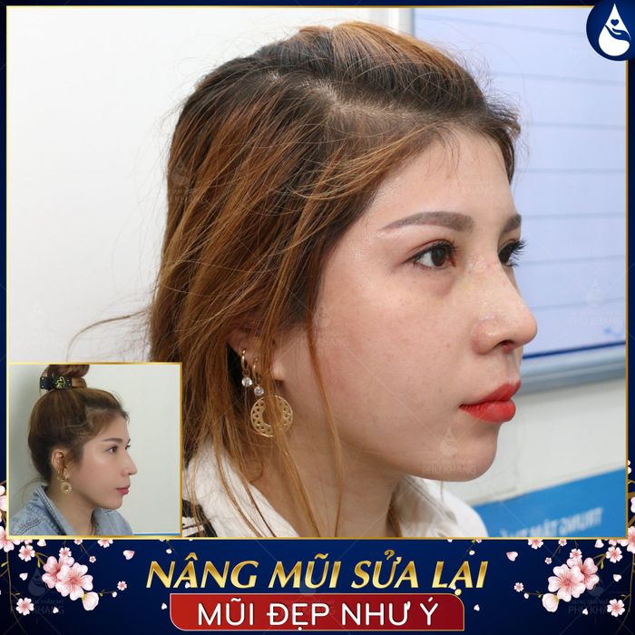Hình ảnh thực tế quy trình sửa mũi hỏng tại Trung Tâm Thẩm Mỹ Phú Khang