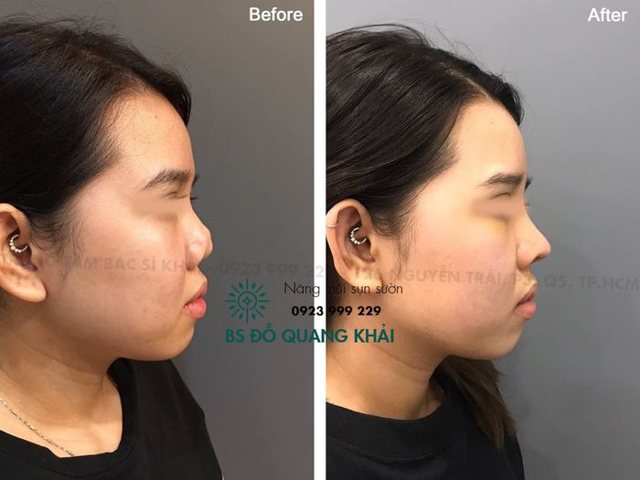 Hình ảnh thực tế quy trình sửa mũi hỏng tại Trung Tâm Thẩm Mỹ Dr. Khải