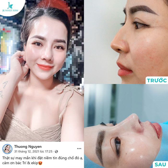 Hình ảnh thực tế quy trình sửa mũi hỏng tại Thẩm Mỹ JK Nhật Hàn
