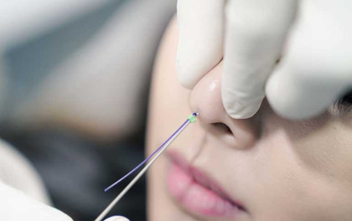Nâng mũi bằng chỉ ảnh 1