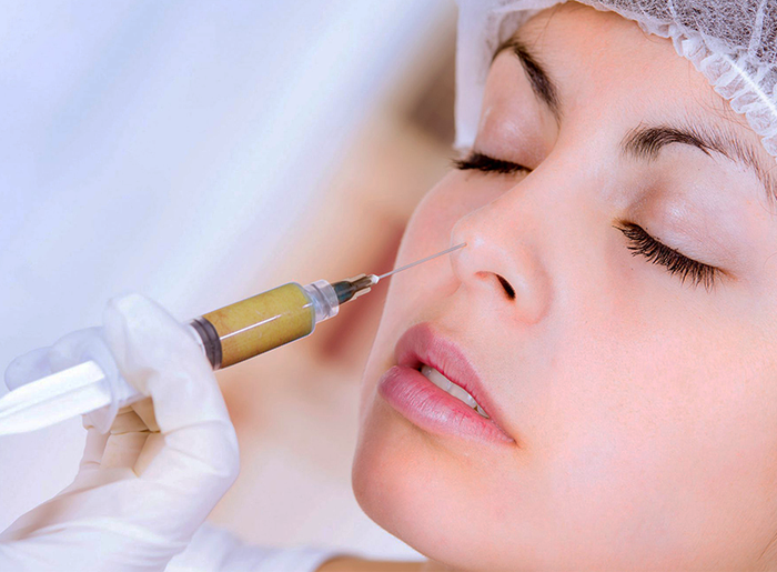 Nâng mũi bằng mỡ tự thân ảnh 1
