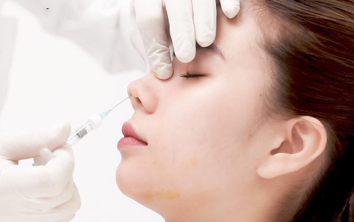 Tiêm filler nâng mũi ảnh 2