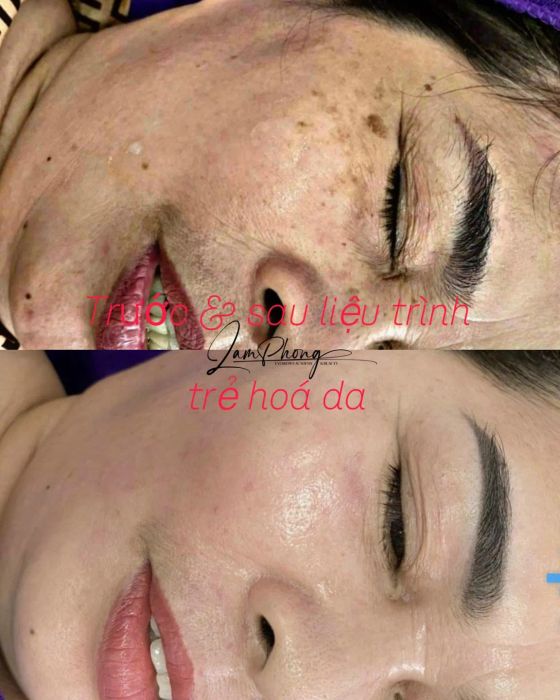 Quy trình chăm sóc da chuyên nghiệp tại Viện Thẩm Mỹ Lâm Phong