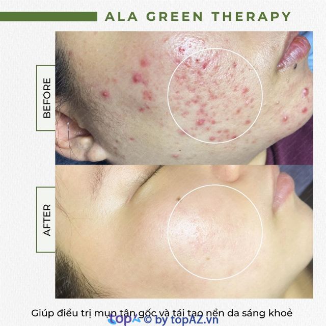 Địa chỉ trị mụn uy tín tại Thủ Đức - nơi mang lại làn da sạch mụn, khỏe mạnh