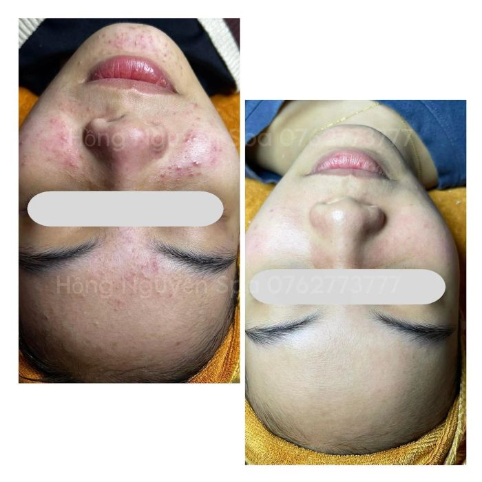 Quy trình trị mụn chuyên nghiệp tại Hồng Nguyễn Spa