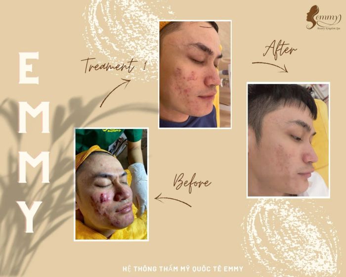 Hình ảnh không gian trị liệu chuyên nghiệp tại Thẩm Mỹ Emmy Huế