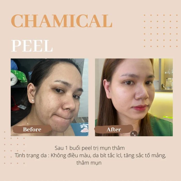 Hình ảnh quy trình trị mụn chuyên nghiệp tại Ly Beauty & Treatment