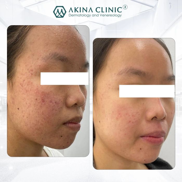 Quy trình trị liệu chuyên nghiệp tại Phòng khám da liễu AKINA Acne