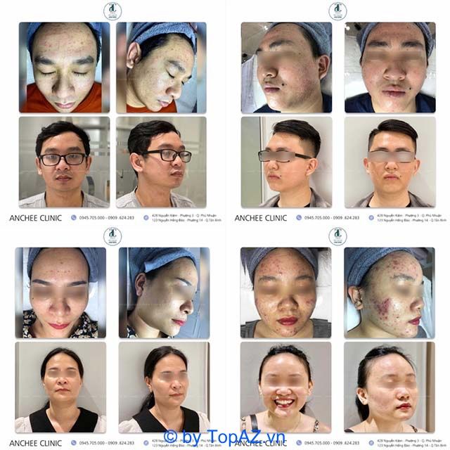 ANCHEE CLINIC – Địa chỉ trị mụn uy tín dành cho nam giới tại TP.HCM.