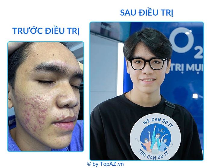 Spa trị mụn cho nam giới tại TPHCM