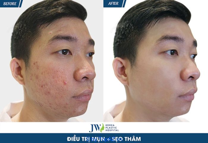 Spa điều trị mụn cho nam giới tại TPHCM