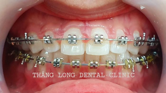 Quy trình niềng răng chuẩn quốc tế tại Nha Khoa Thăng Long