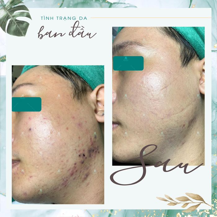 Hana Spa & Clinic - Hình ảnh thực tế trị liệu da