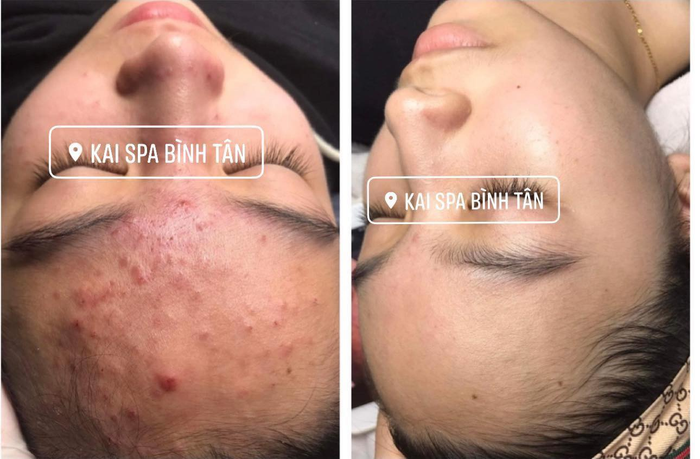 Hình ảnh quy trình trị liệu chuyên nghiệp tại Kai Spa