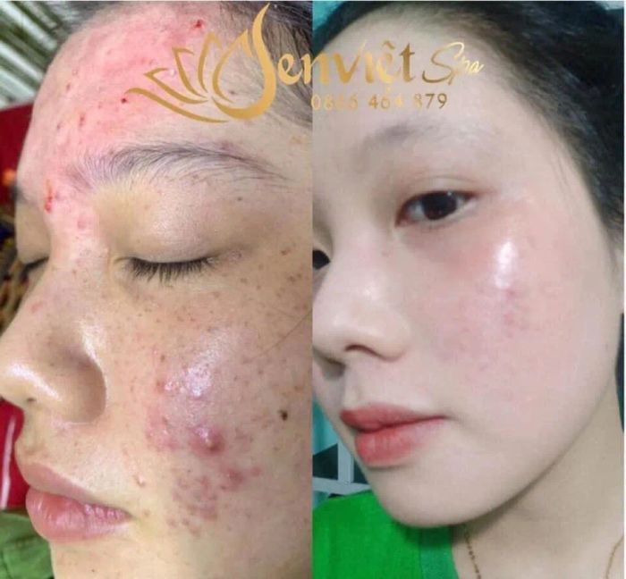 Hình ảnh quy trình trị liệu chuyên nghiệp tại Spa Sen Việt