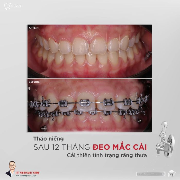 Hình ảnh quy trình niềng răng chuyên nghiệp
