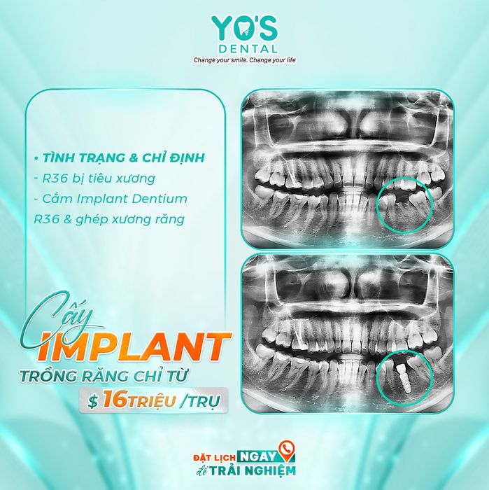 Hình ảnh quy trình cấy ghép tại Nha khoa Sài Gòn Bình Dương