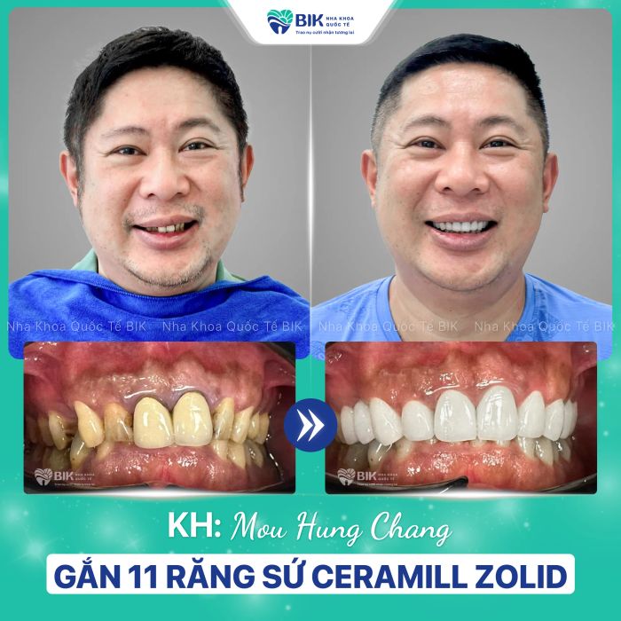 Hình ảnh quy trình bọc răng sứ chuẩn quốc tế tại BIK