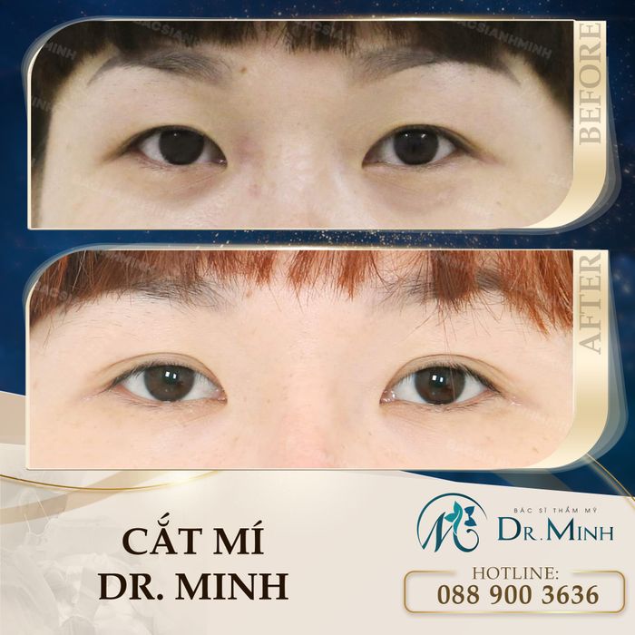 Hình ảnh thực tế kết quả thẩm mỹ mắt tại Viện Thẩm Mỹ Y Khoa Dr. Minh