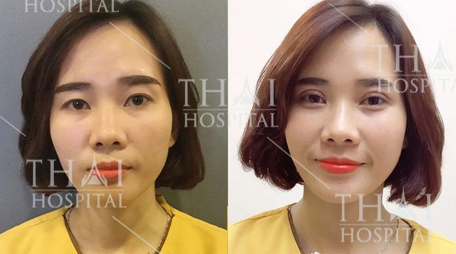 Hình ảnh kết quả cắt mí ấn tượng tại Thẩm Mỹ Viện Thai Hospital