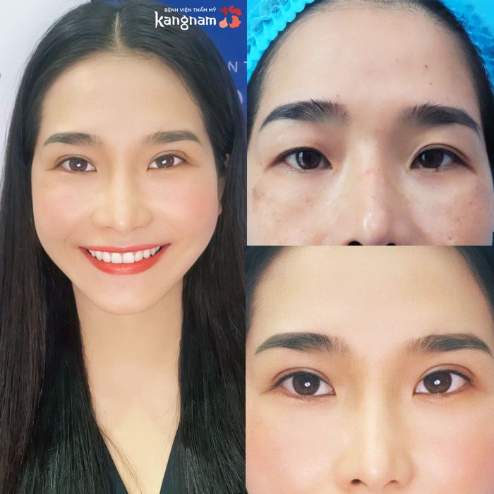 Hình ảnh kết quả thẩm mỹ mắt ấn tượng tại Kangnam