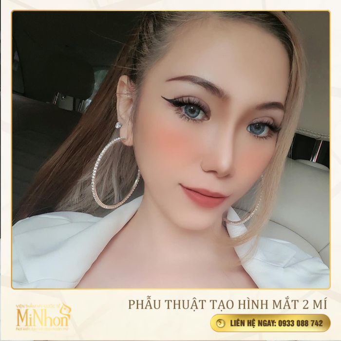 Hình ảnh kết quả thẩm mỹ mắt ấn tượng tại Viện Thẩm Mỹ MiNhon