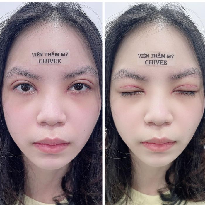 Hình ảnh kết quả cắt mí ấn tượng tại Viện Thẩm Mỹ ChiVee