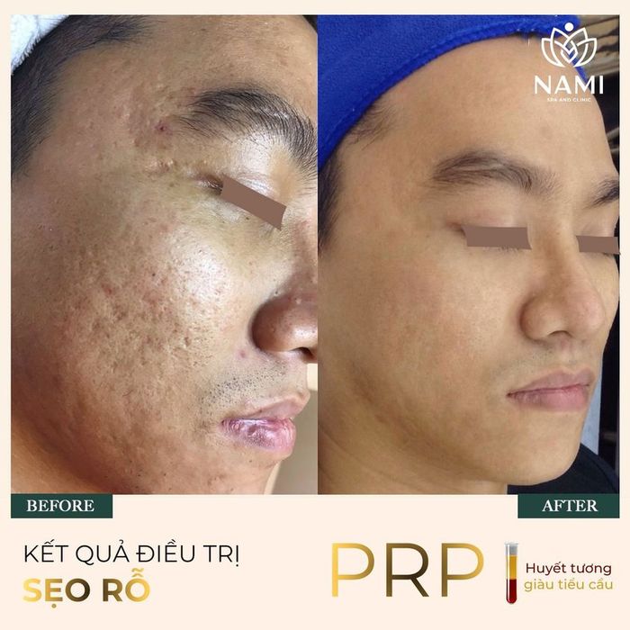 Hình ảnh quy trình điều trị chuyên nghiệp tại Nami Spa Beauty & Clinic