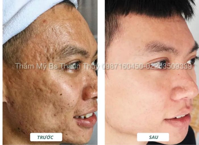 Hình ảnh quy trình điều trị sẹo rỗ chuyên nghiệp tại Thẩm mỹ viện Bác sĩ Thành Thủy