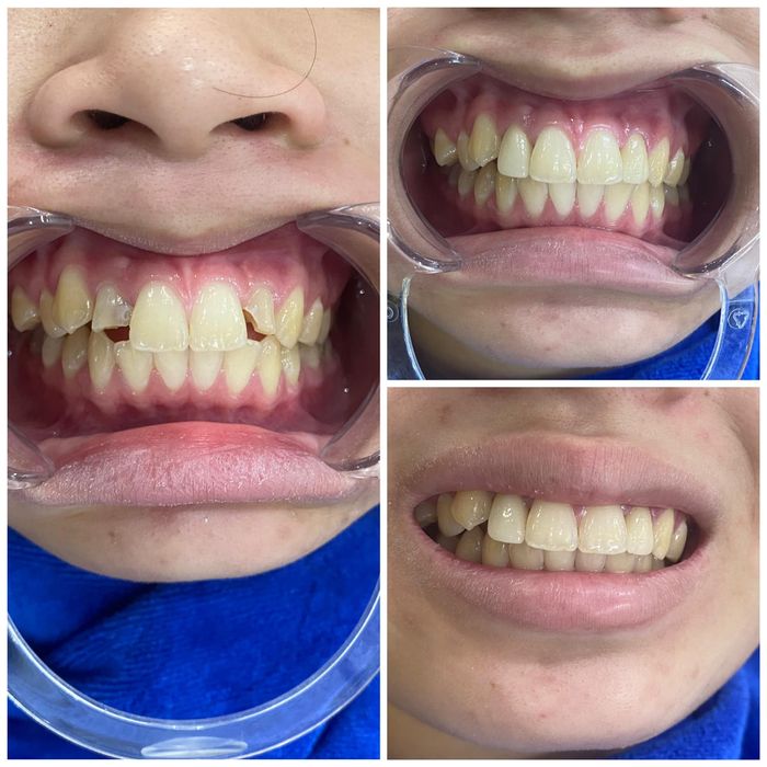 Hệ thống trang thiết bị tân tiến và quy trình chuẩn tại Nha Khoa Blue Dental