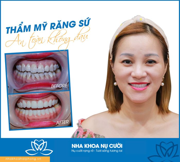 Hình ảnh thực tế về quy trình điều trị tại Nha Khoa Nụ Cười Hải Phòng