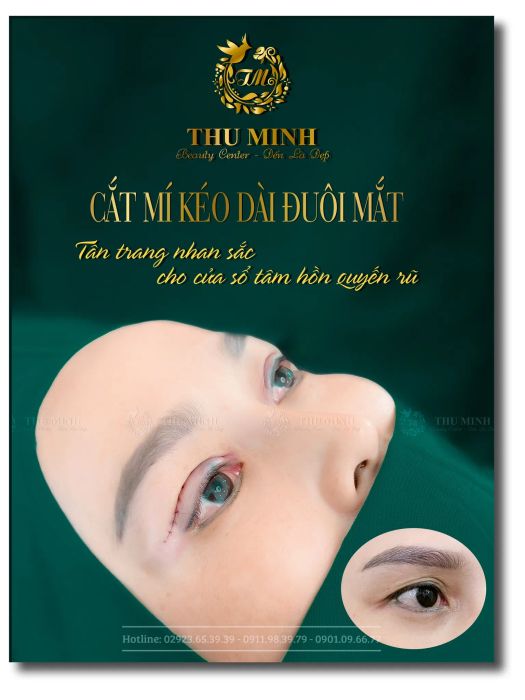 Kết quả cắt mí ấn tượng tại Thẩm mỹ viện Thu Minh