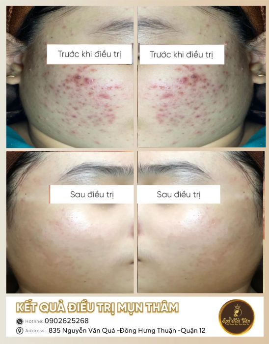 Quy trình điều trị mụn chuẩn y khoa tại Hải Vân Spa
