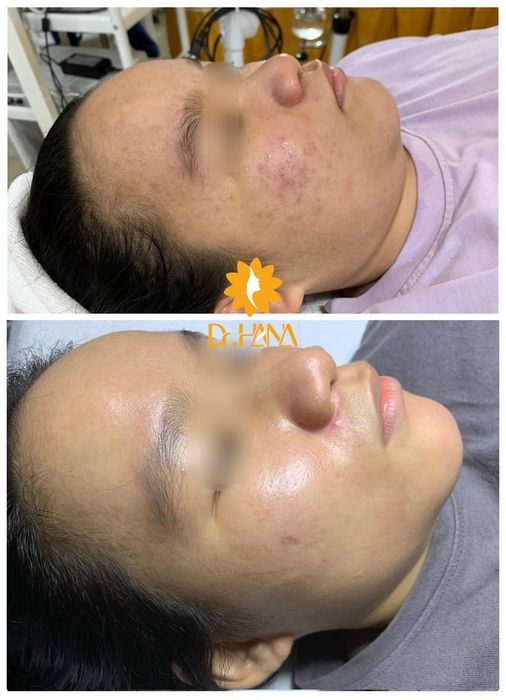Quy trình điều trị chuyên nghiệp tại Viện Thẩm Mỹ Dr.Hana