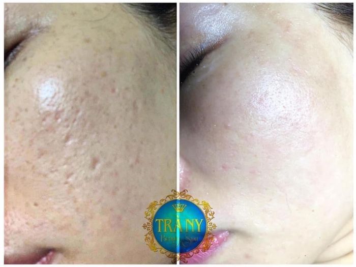 Hình ảnh quy trình điều trị chuyên nghiệp tại Trà Ny Spa
