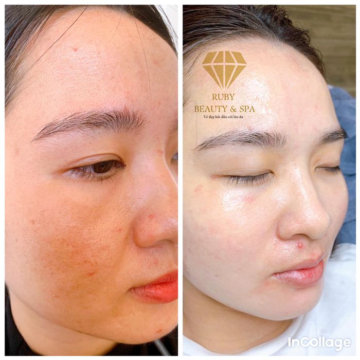 Hình ảnh quy trình điều trị chuyên nghiệp tại Ruby Beauty & Spa