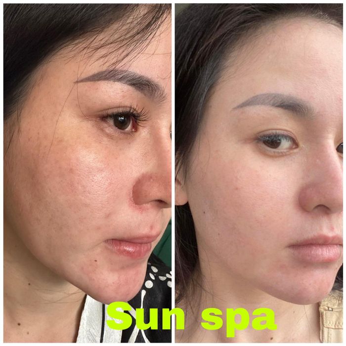 Hình ảnh quy trình điều trị chuyên nghiệp tại Sun Spa